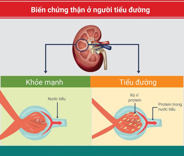 Tiểu đường ảnh hưởng đến bệnh thận như thế nào