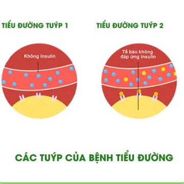 Tiểu đường tuýp 1 và tuýp 2 khác nhau như thế nào?